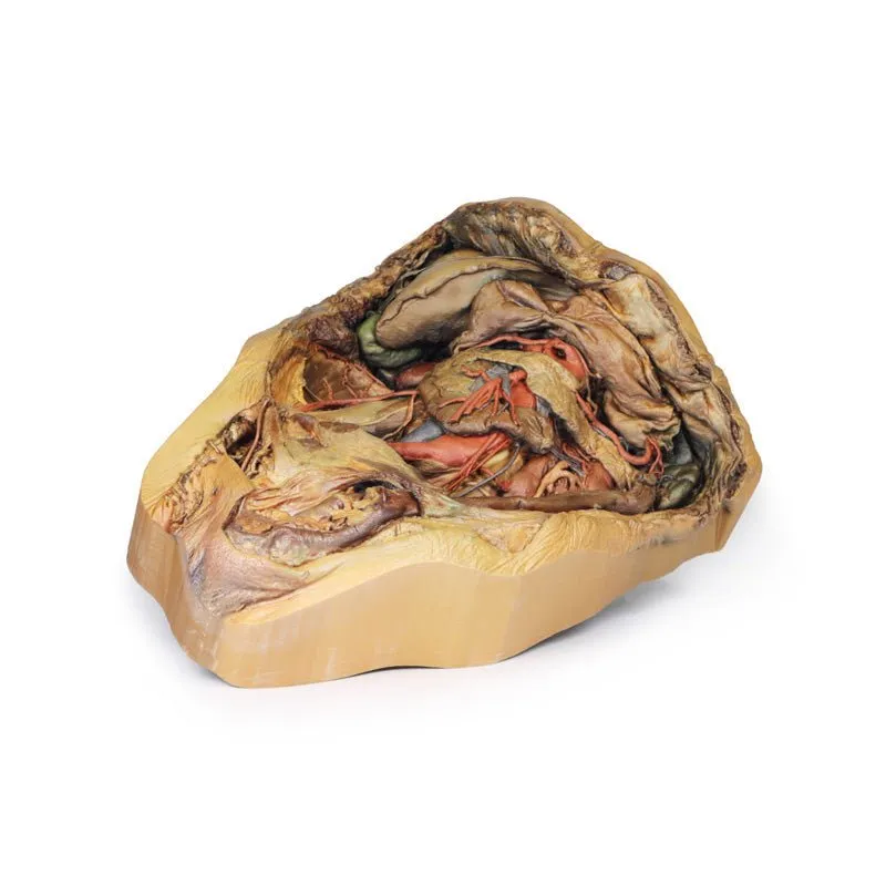 3D Printed Abdomen with Inguinal Hernia