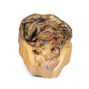 3D Printed Abdomen with Inguinal Hernia